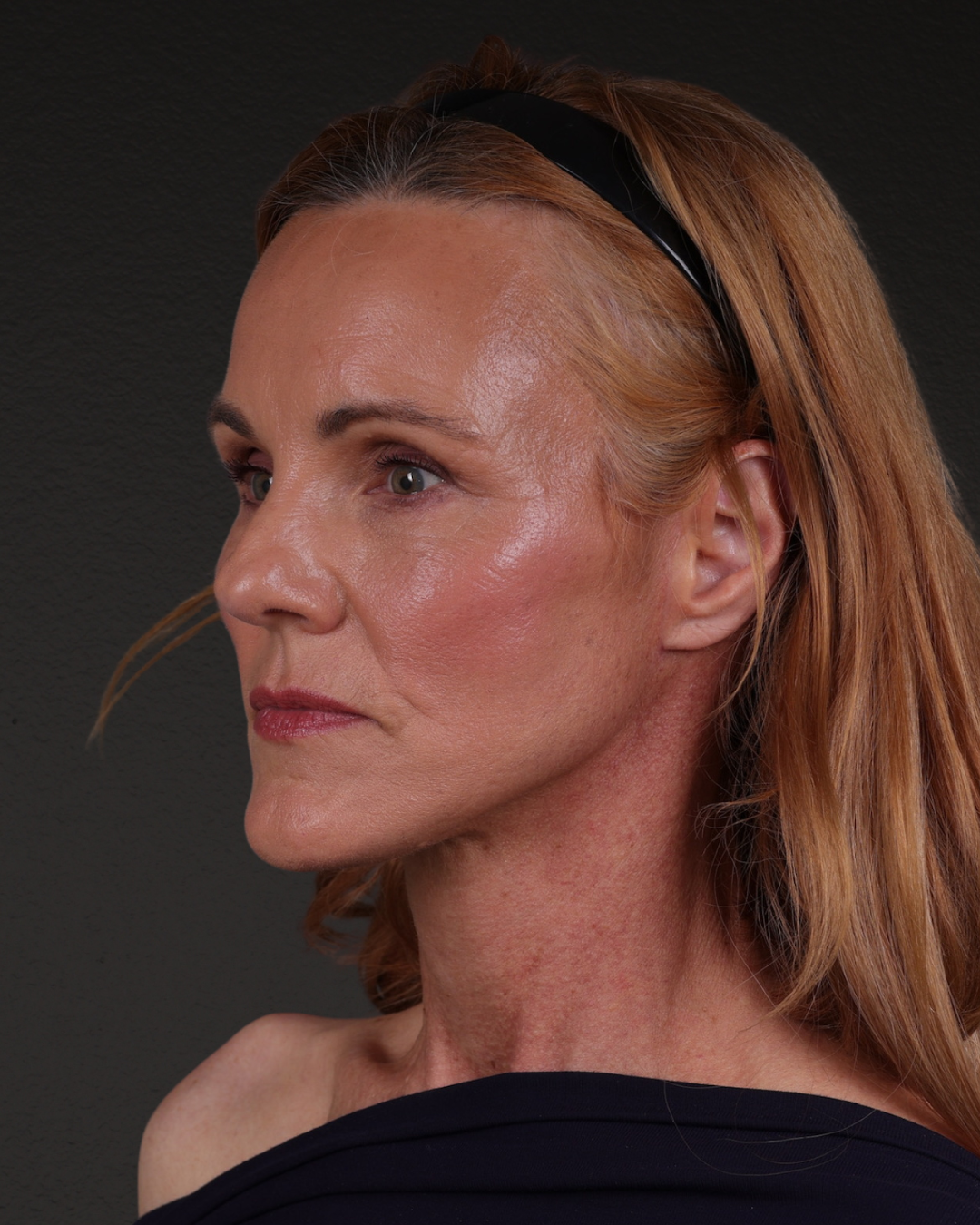 Facelift Before & After Gallery - Patient 298435 - Image 8
