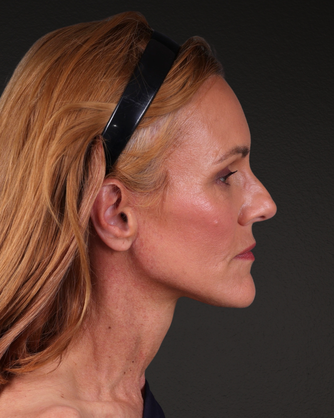 Facelift Before & After Gallery - Patient 298435 - Image 6
