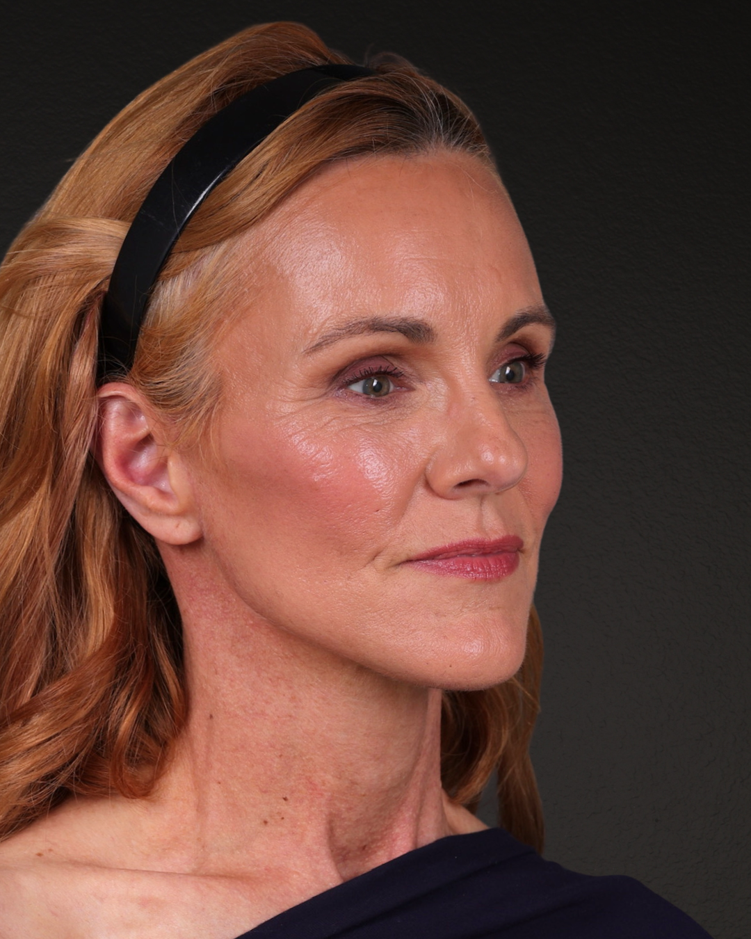 Facelift Before & After Gallery - Patient 298435 - Image 4