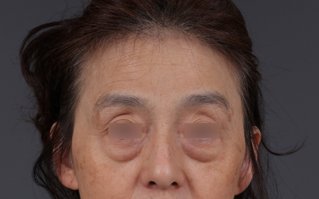 Blepharoplasty Before & After Gallery - Patient 189111 - Image 1