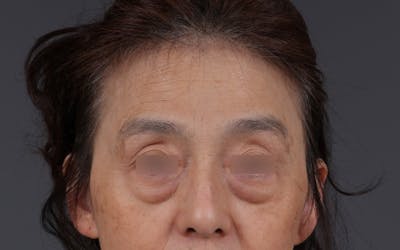 Blepharoplasty Before & After Gallery - Patient 189111 - Image 1