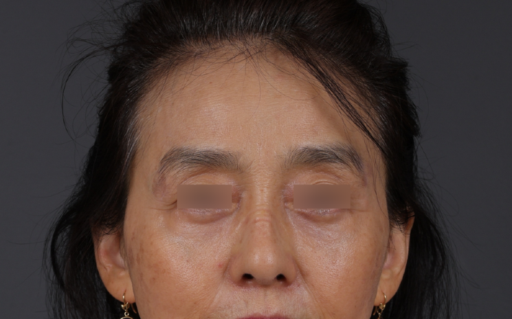 Blepharoplasty Before & After Gallery - Patient 189111 - Image 2