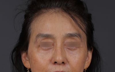 Blepharoplasty Before & After Gallery - Patient 189111 - Image 2