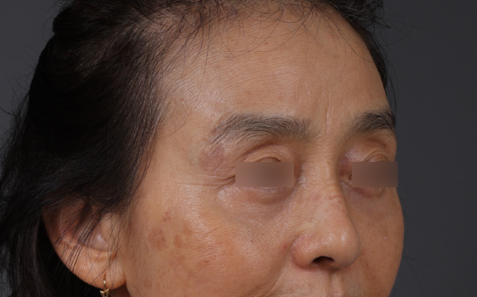 Blepharoplasty Before & After Gallery - Patient 189111 - Image 6