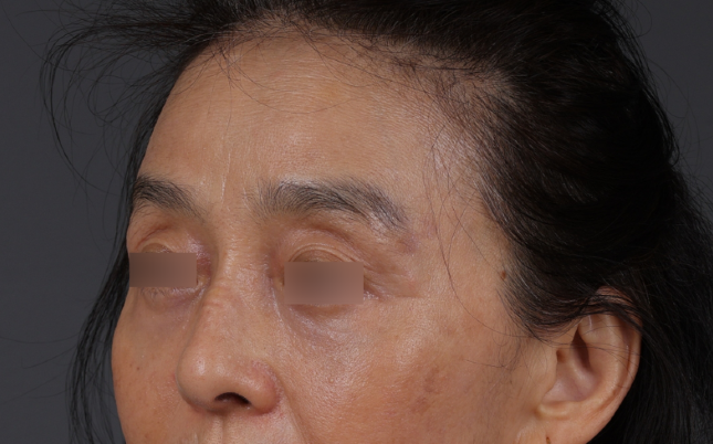 Blepharoplasty Before & After Gallery - Patient 189111 - Image 4