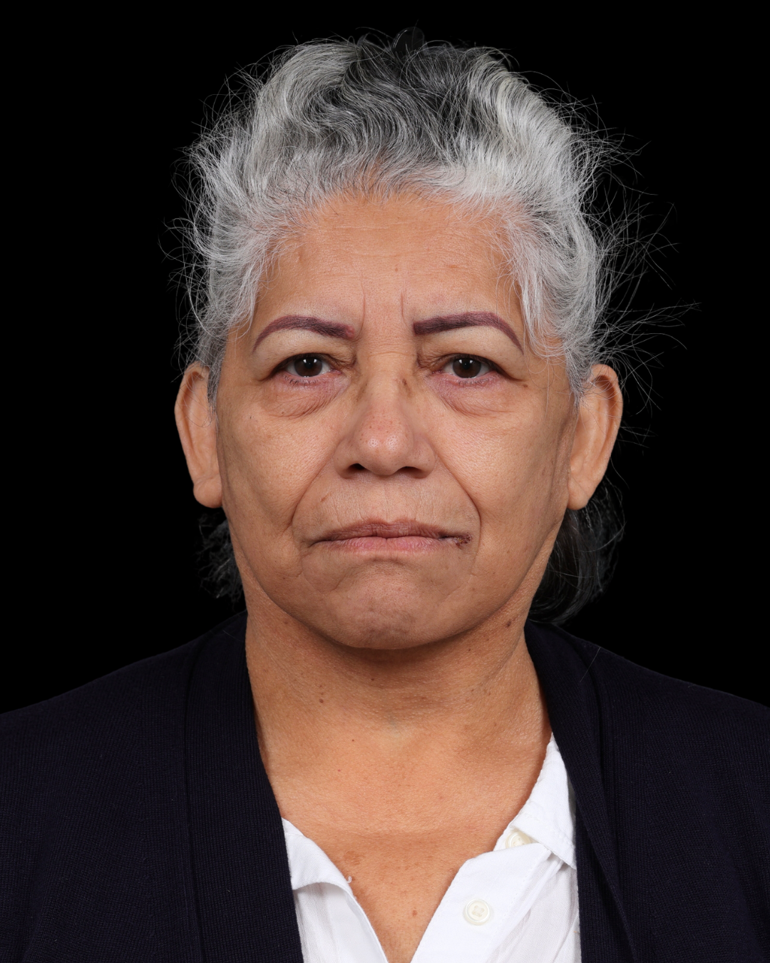 Facelift Before & After Gallery - Patient 364819 - Image 4