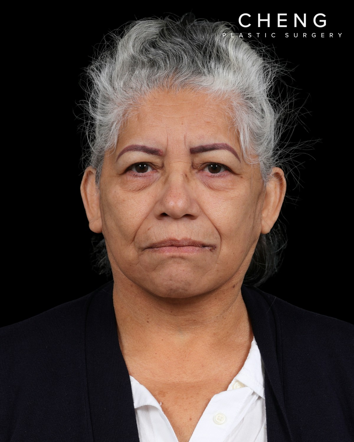 Facelift Before & After Gallery - Patient 364819 - Image 4