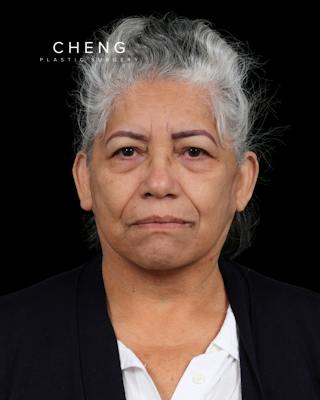 Facelift Before & After Gallery - Patient 364819 - Image 4