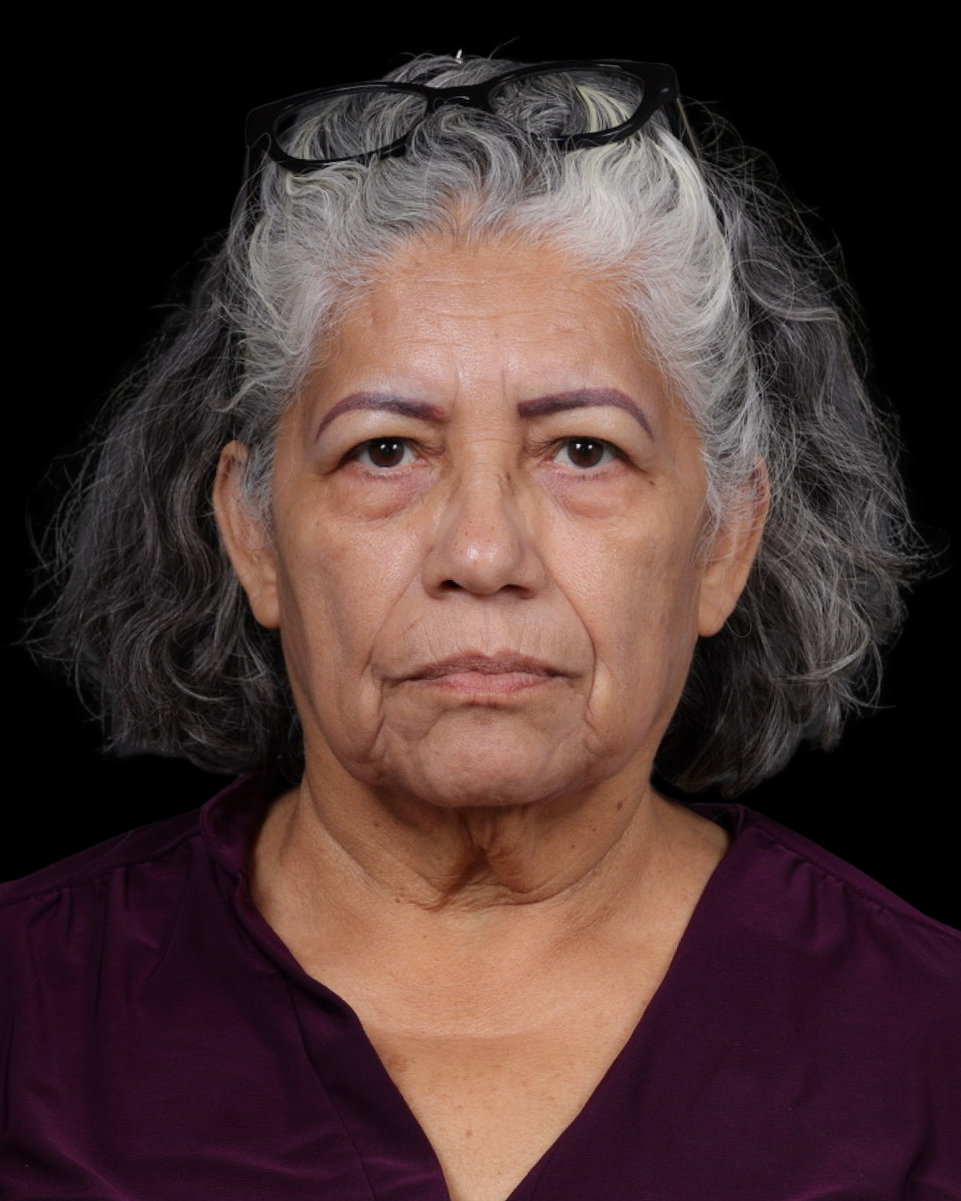 Facelift Before & After Gallery - Patient 364819 - Image 3