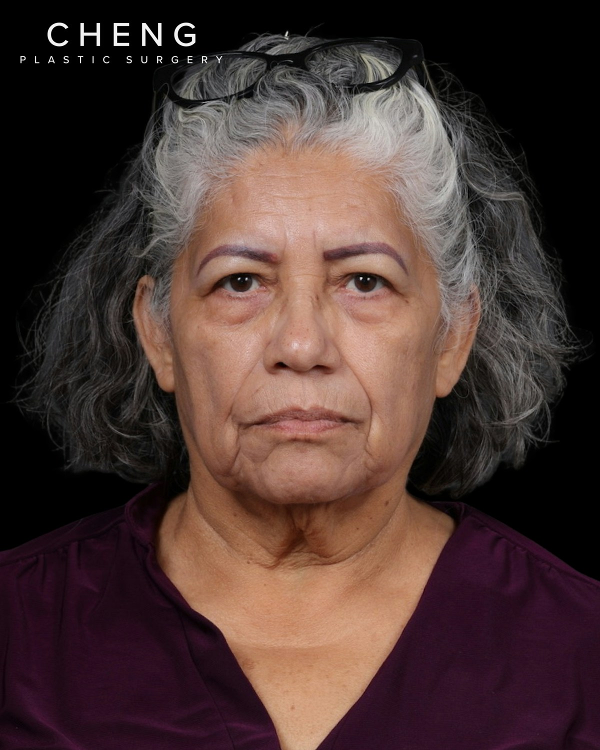 Facelift Before & After Gallery - Patient 364819 - Image 3
