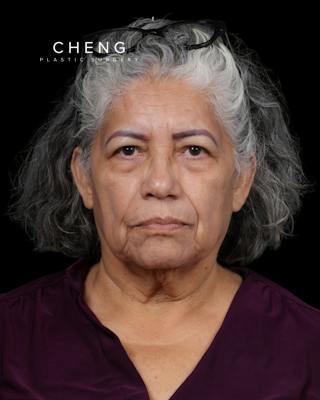 Facelift Before & After Gallery - Patient 364819 - Image 3