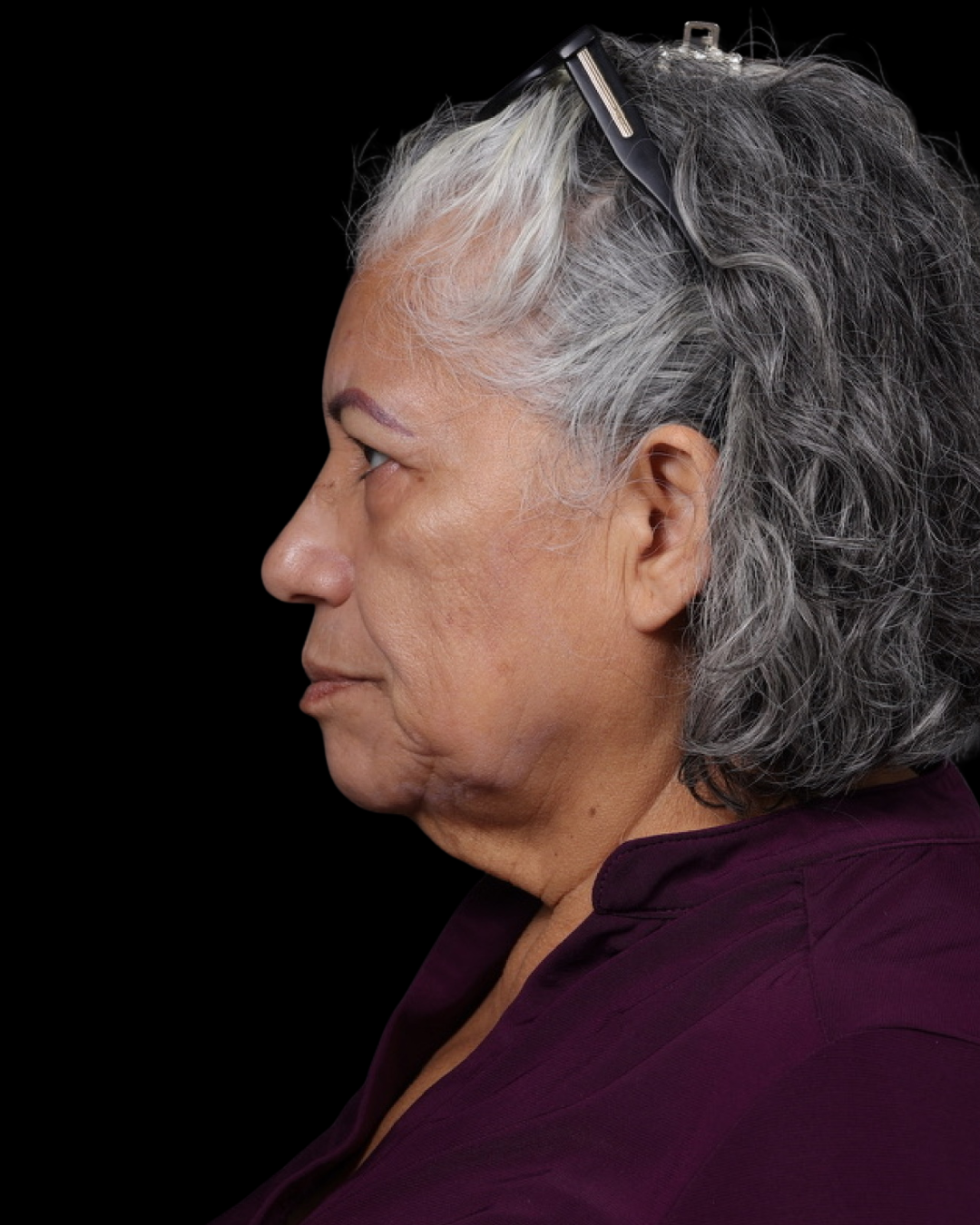 Facelift Before & After Gallery - Patient 364819 - Image 11
