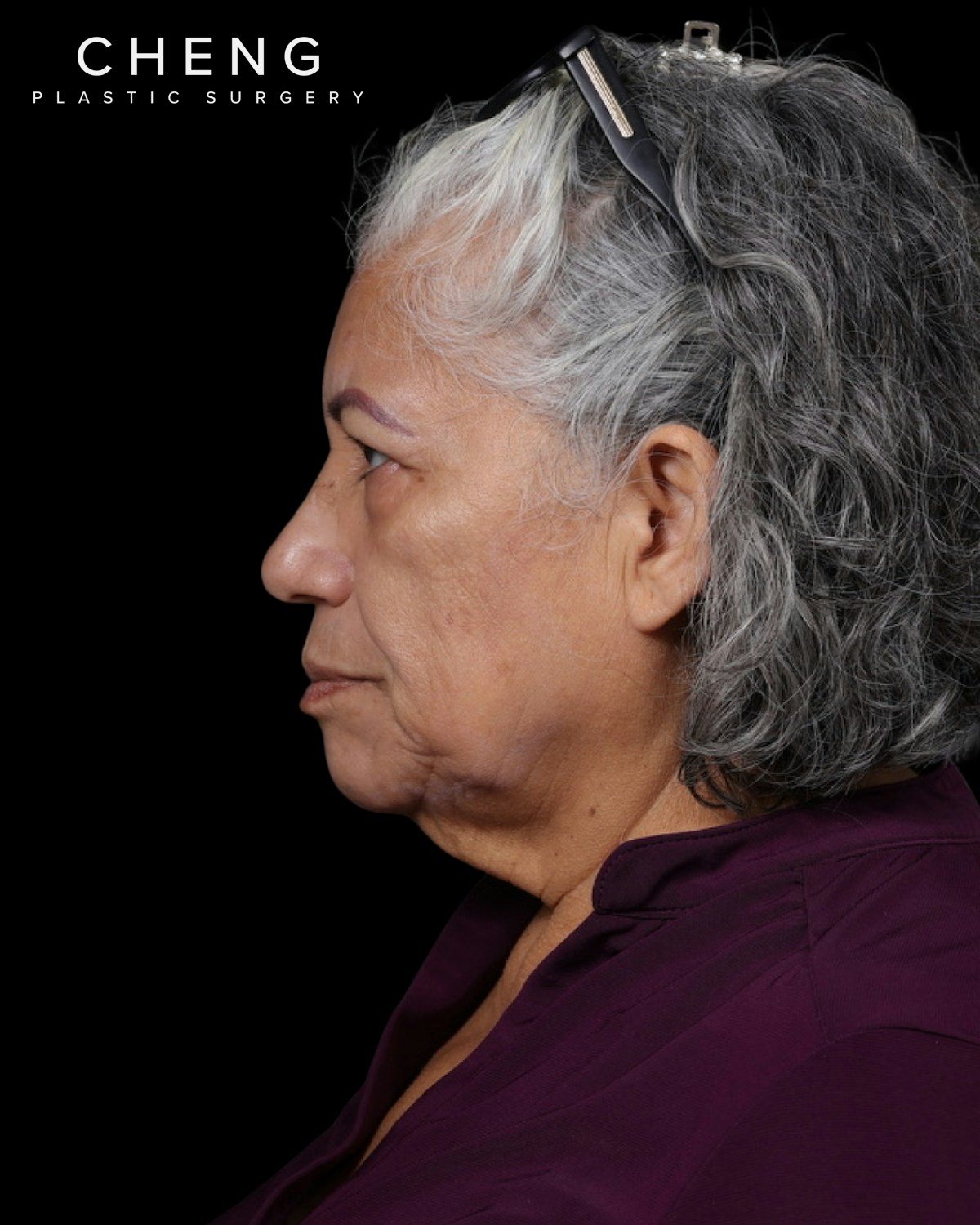 Facelift Before & After Gallery - Patient 364819 - Image 11