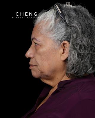 Facelift Before & After Gallery - Patient 364819 - Image 11