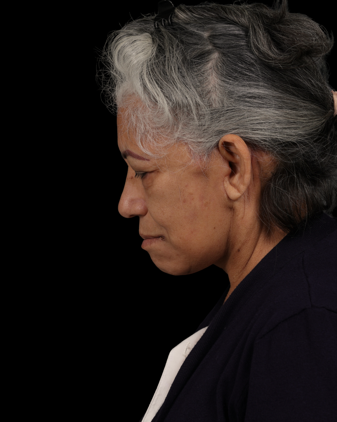 Facelift Before & After Gallery - Patient 364819 - Image 14