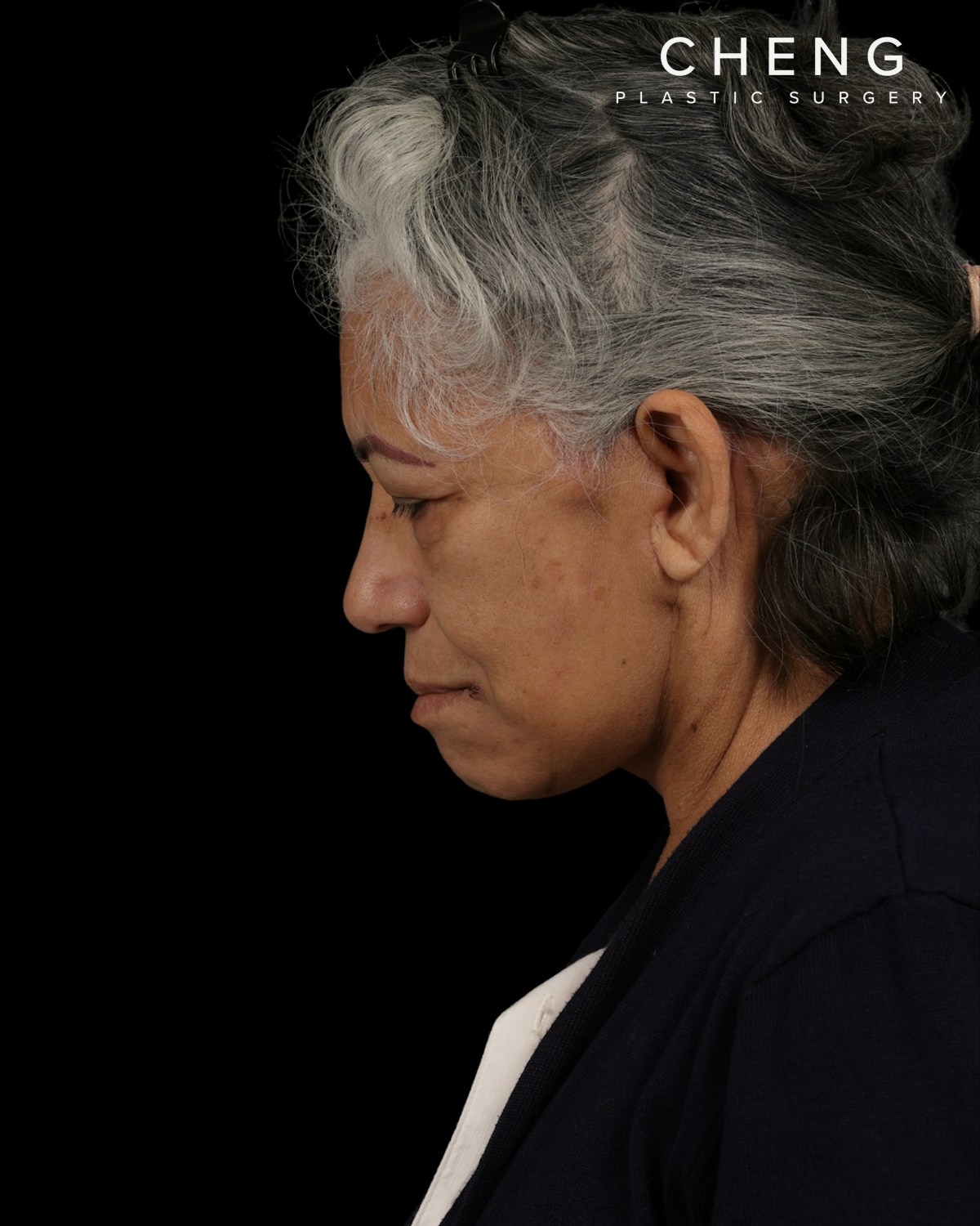 Facelift Before & After Gallery - Patient 364819 - Image 14