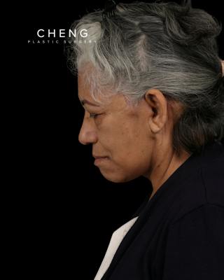 Facelift Before & After Gallery - Patient 364819 - Image 14