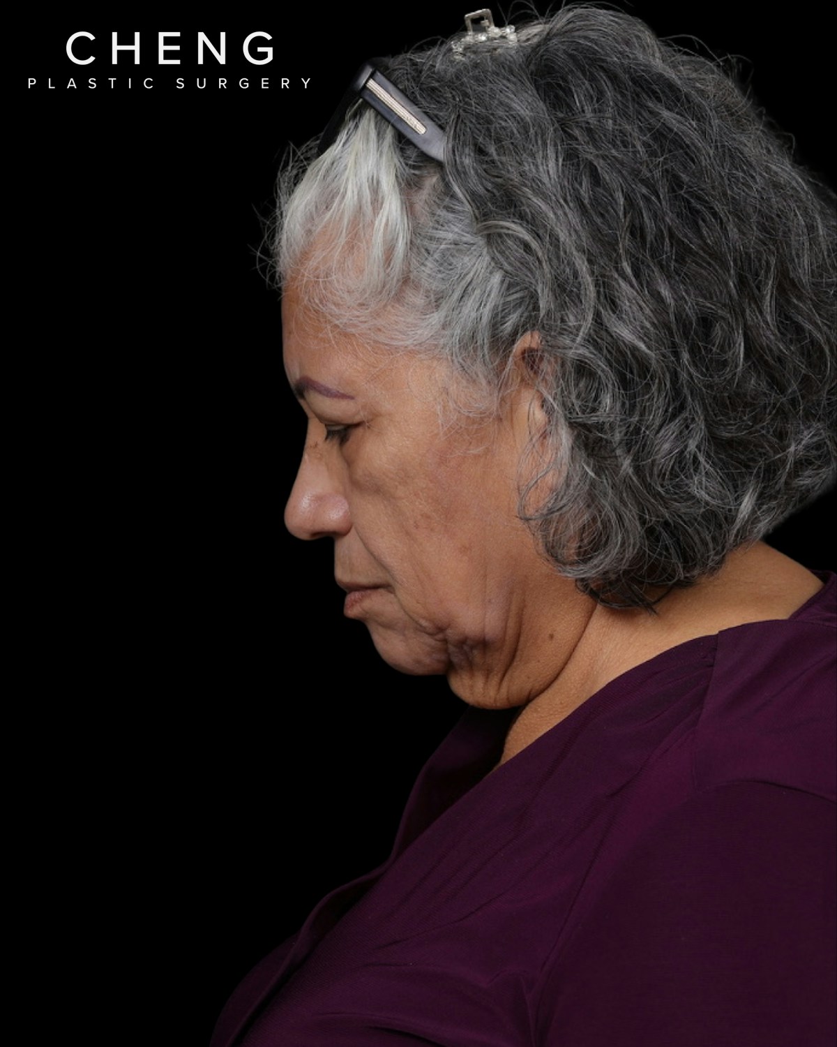 Facelift Before & After Gallery - Patient 364819 - Image 13