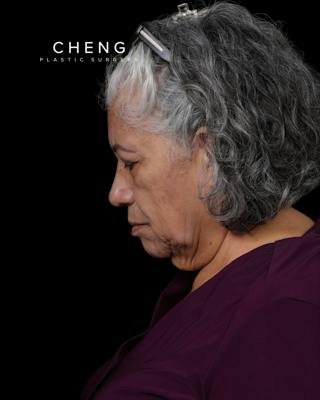 Facelift Before & After Gallery - Patient 364819 - Image 13