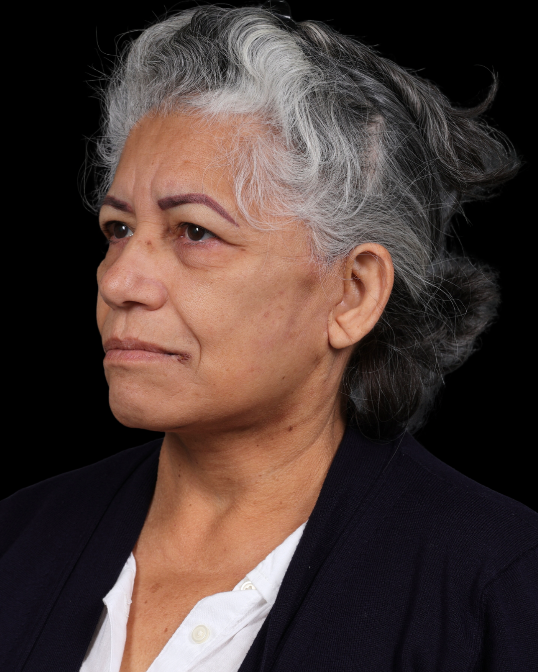 Facelift Before & After Gallery - Patient 364819 - Image 10