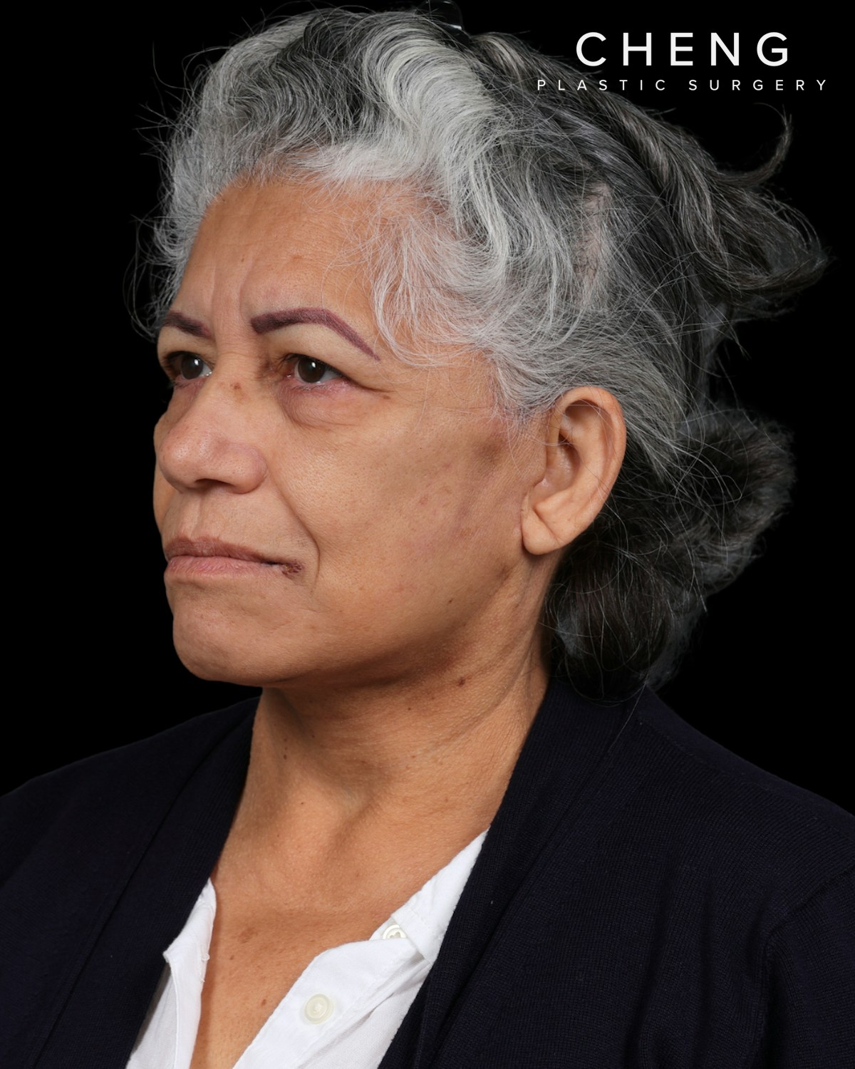 Facelift Before & After Gallery - Patient 364819 - Image 10
