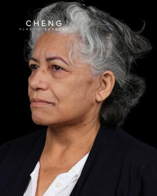 Facelift Before & After Gallery - Patient 364819 - Image 10