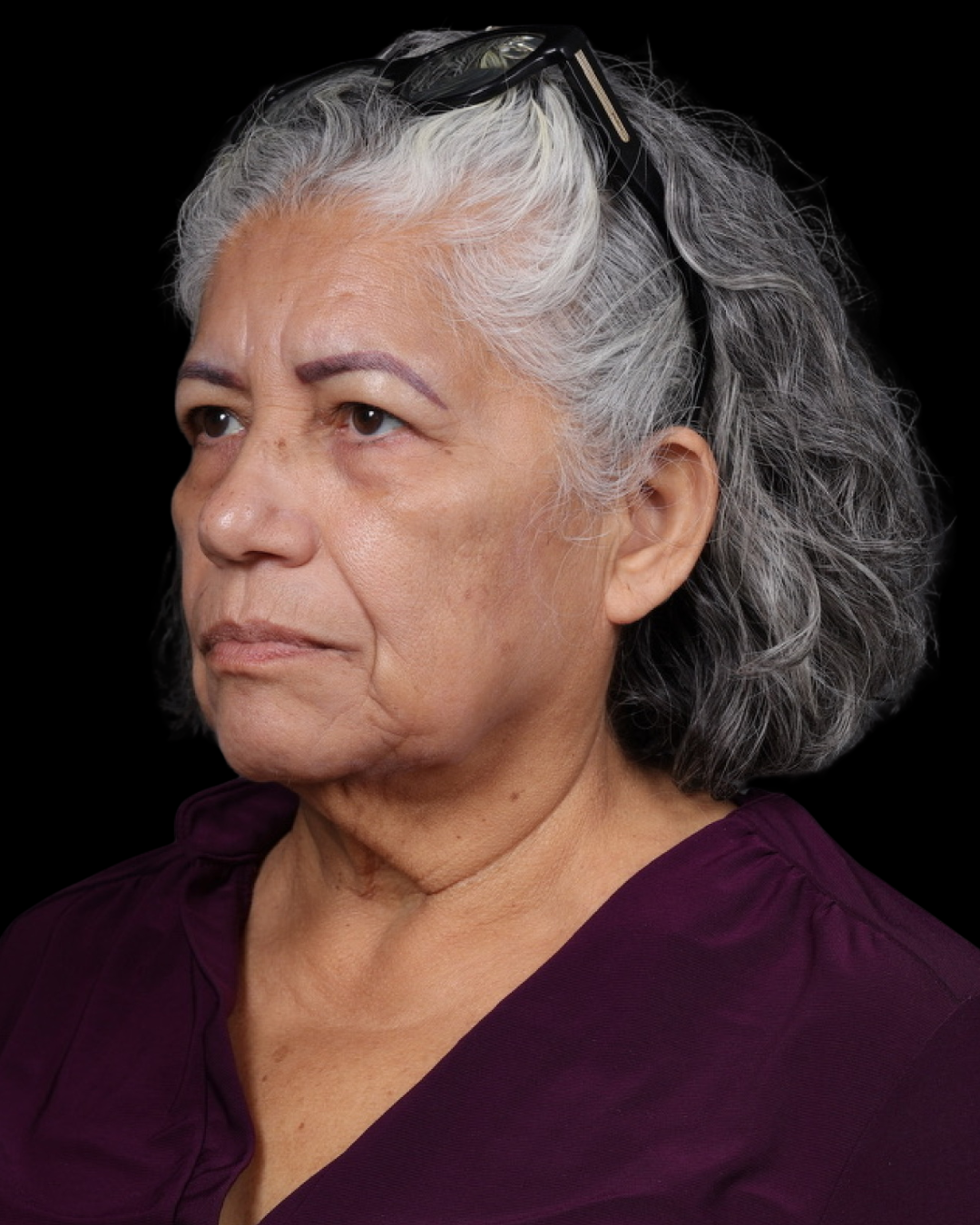 Facelift Before & After Gallery - Patient 364819 - Image 9