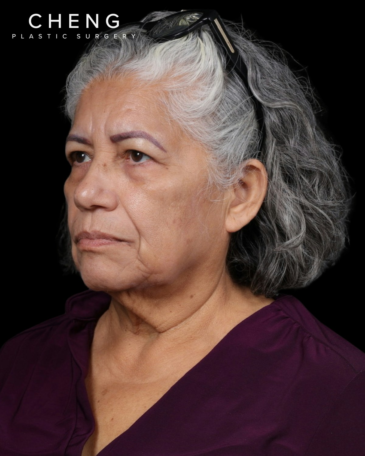 Facelift Before & After Gallery - Patient 364819 - Image 9