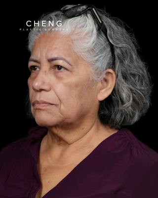 Facelift Before & After Gallery - Patient 364819 - Image 9