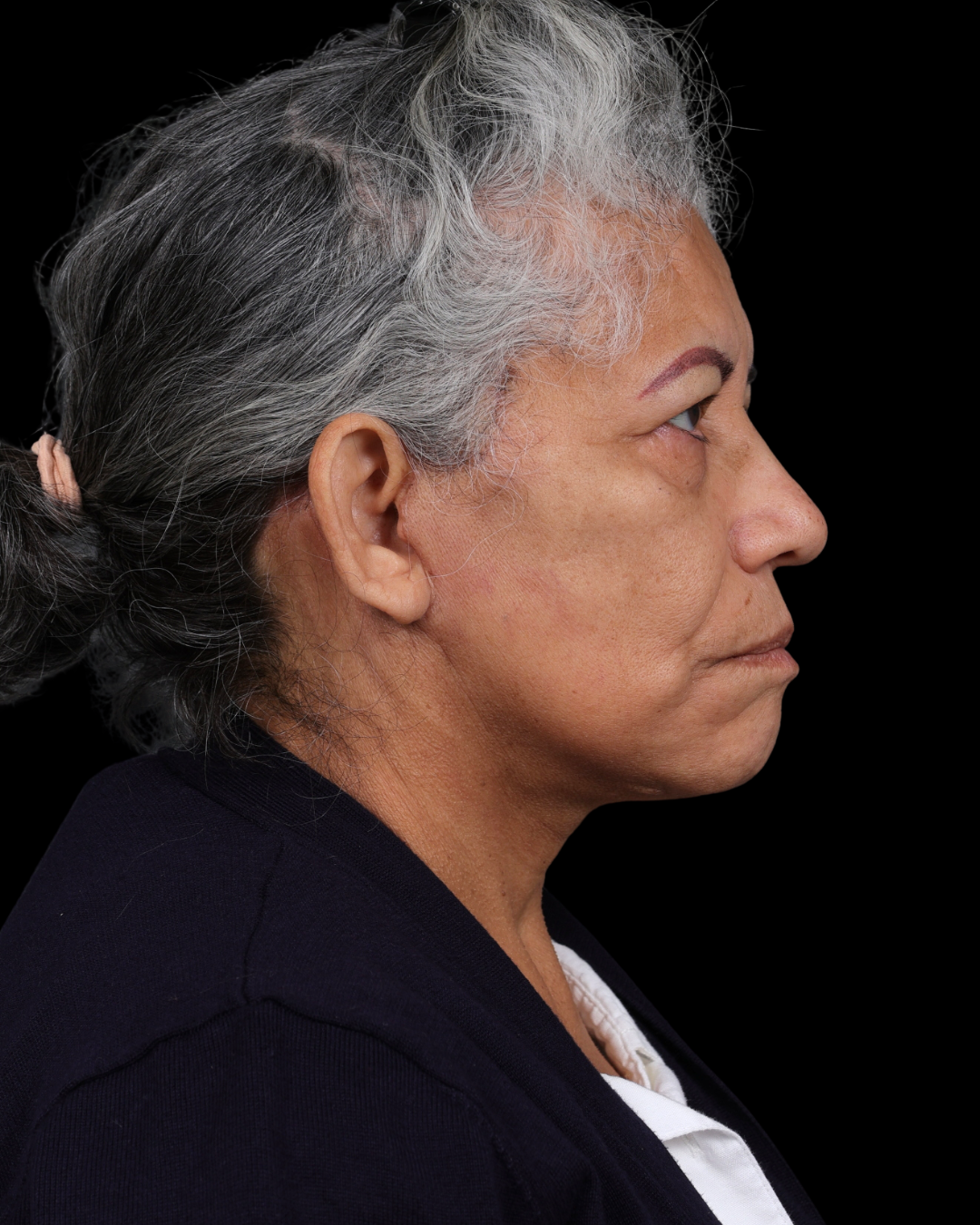 Facelift Before & After Gallery - Patient 364819 - Image 6