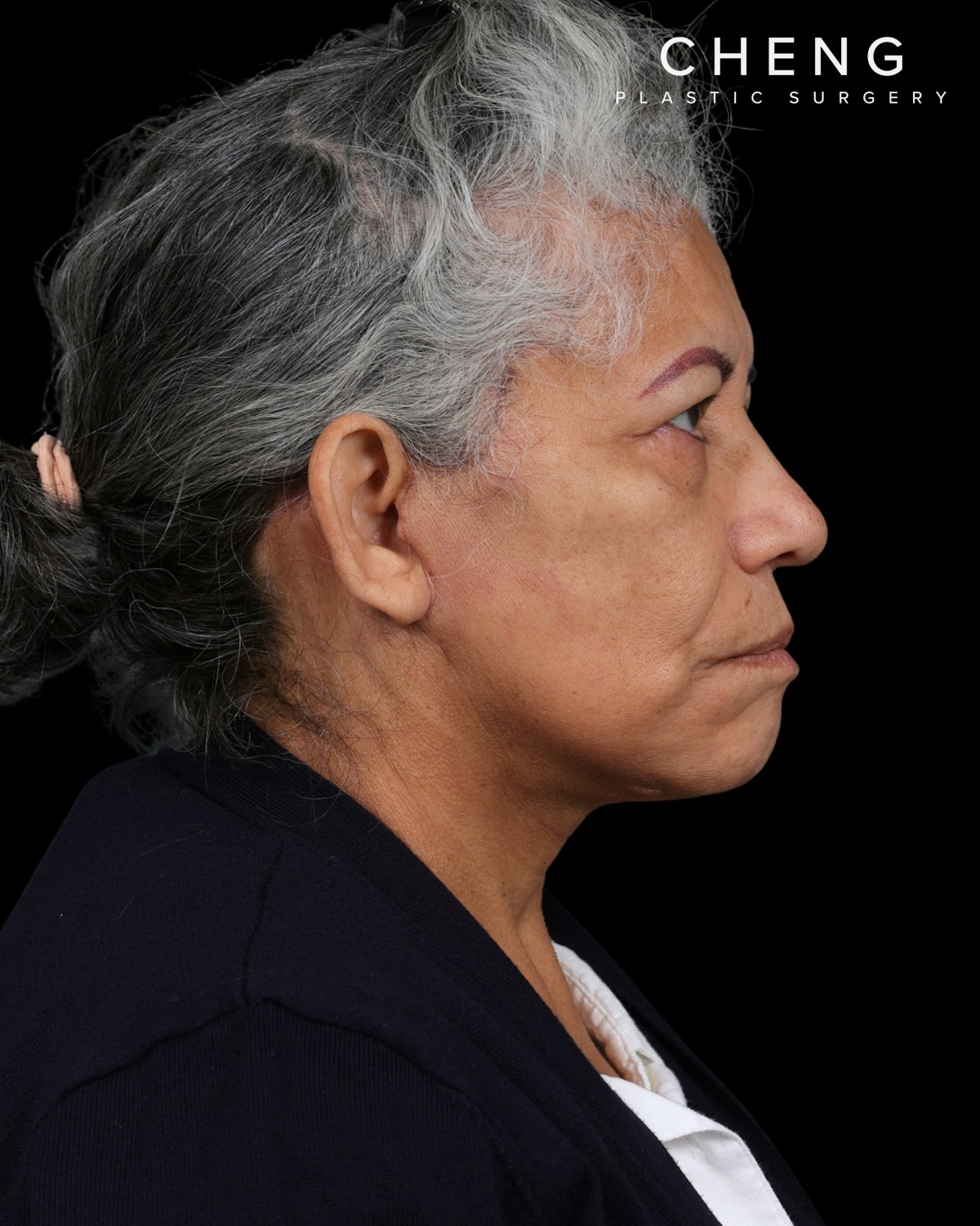 Facelift Before & After Gallery - Patient 364819 - Image 6