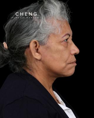 Facelift Before & After Gallery - Patient 364819 - Image 6