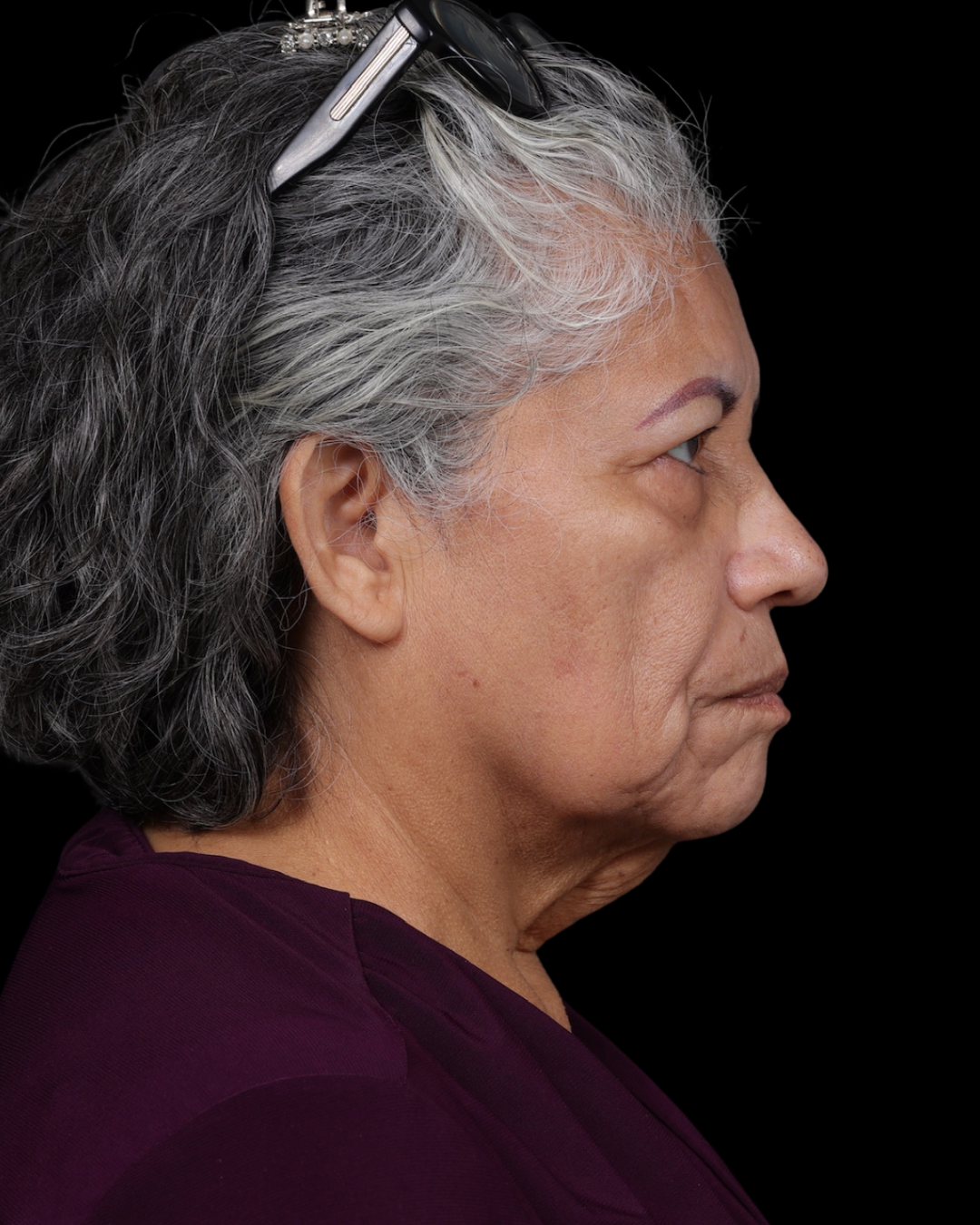 Facelift Before & After Gallery - Patient 364819 - Image 5