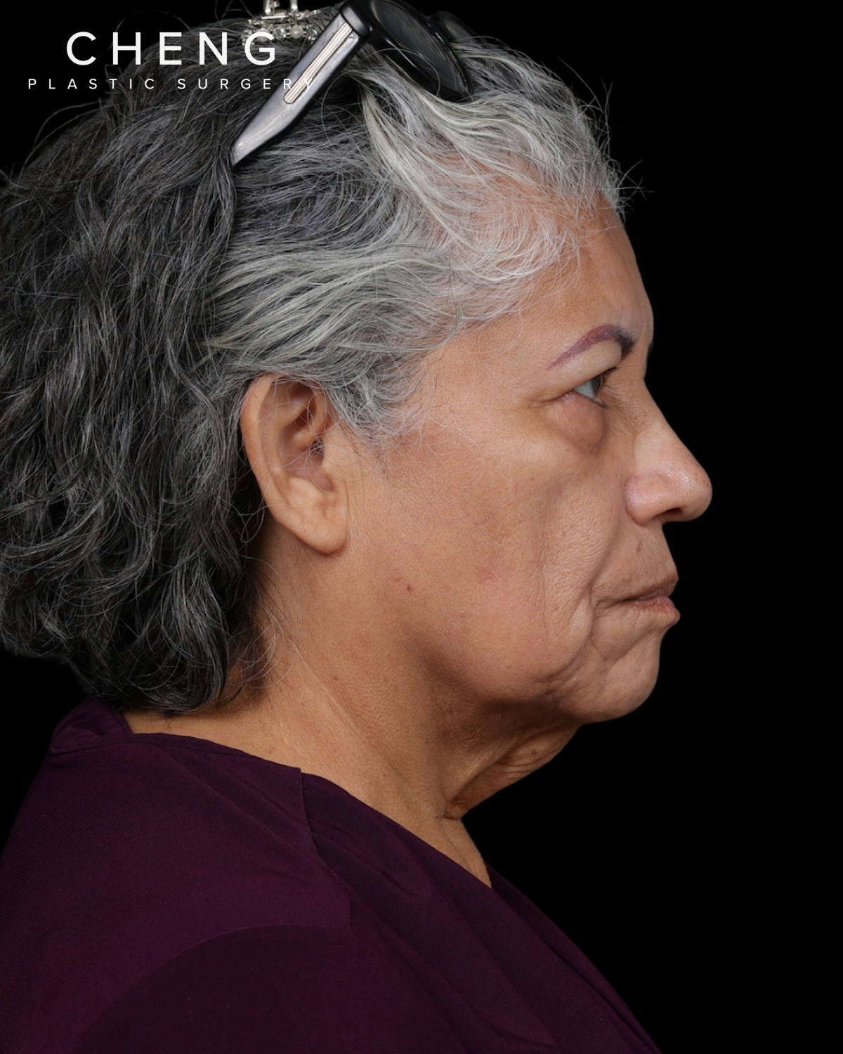 Facelift Before & After Gallery - Patient 364819 - Image 5