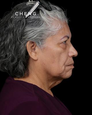 Facelift Before & After Gallery - Patient 364819 - Image 5