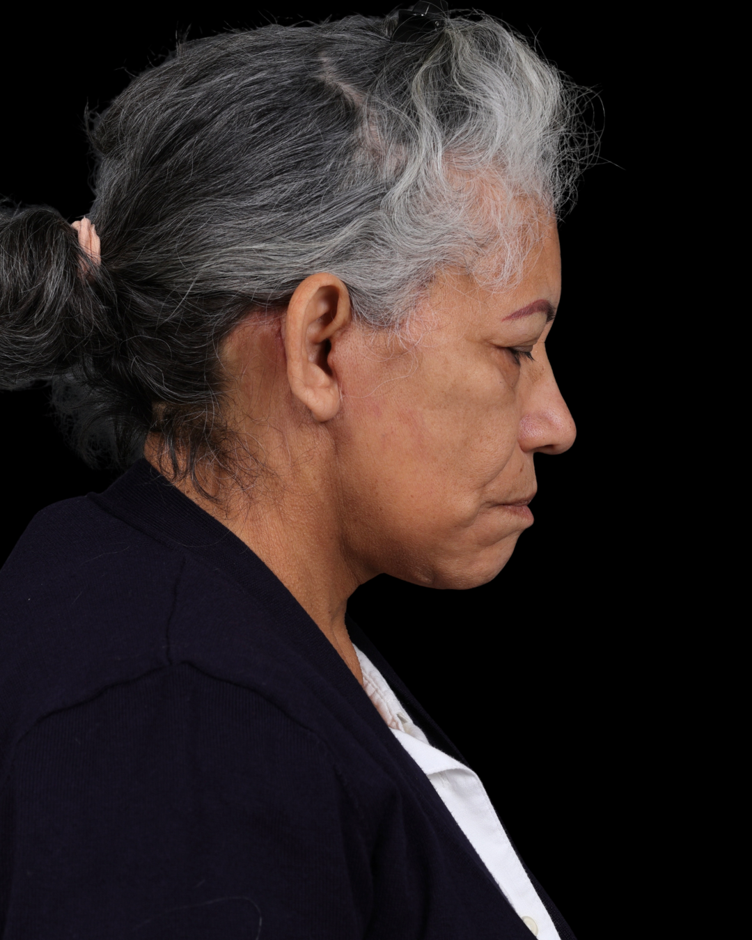 Facelift Before & After Gallery - Patient 364819 - Image 8