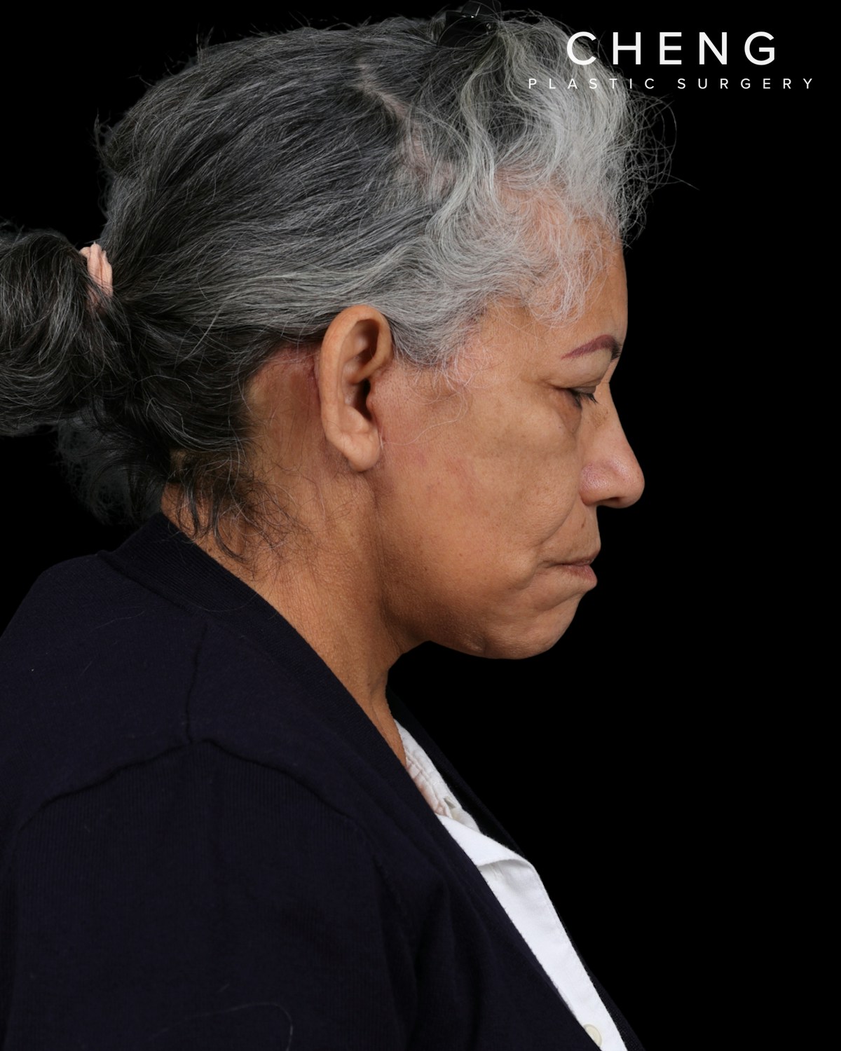 Facelift Before & After Gallery - Patient 364819 - Image 8