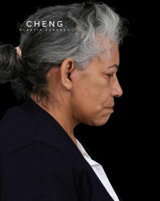 Facelift Before & After Gallery - Patient 364819 - Image 8