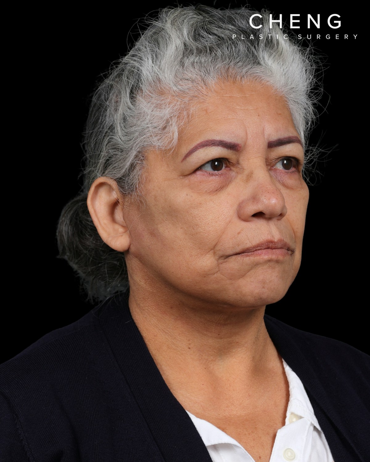 Facelift Before & After Gallery - Patient 364819 - Image 2