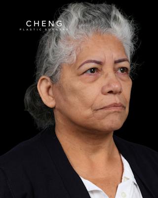 Facelift Before & After Gallery - Patient 364819 - Image 2