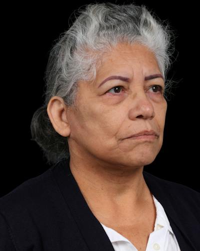 Facelift Before & After Gallery - Patient 364819 - Image 2