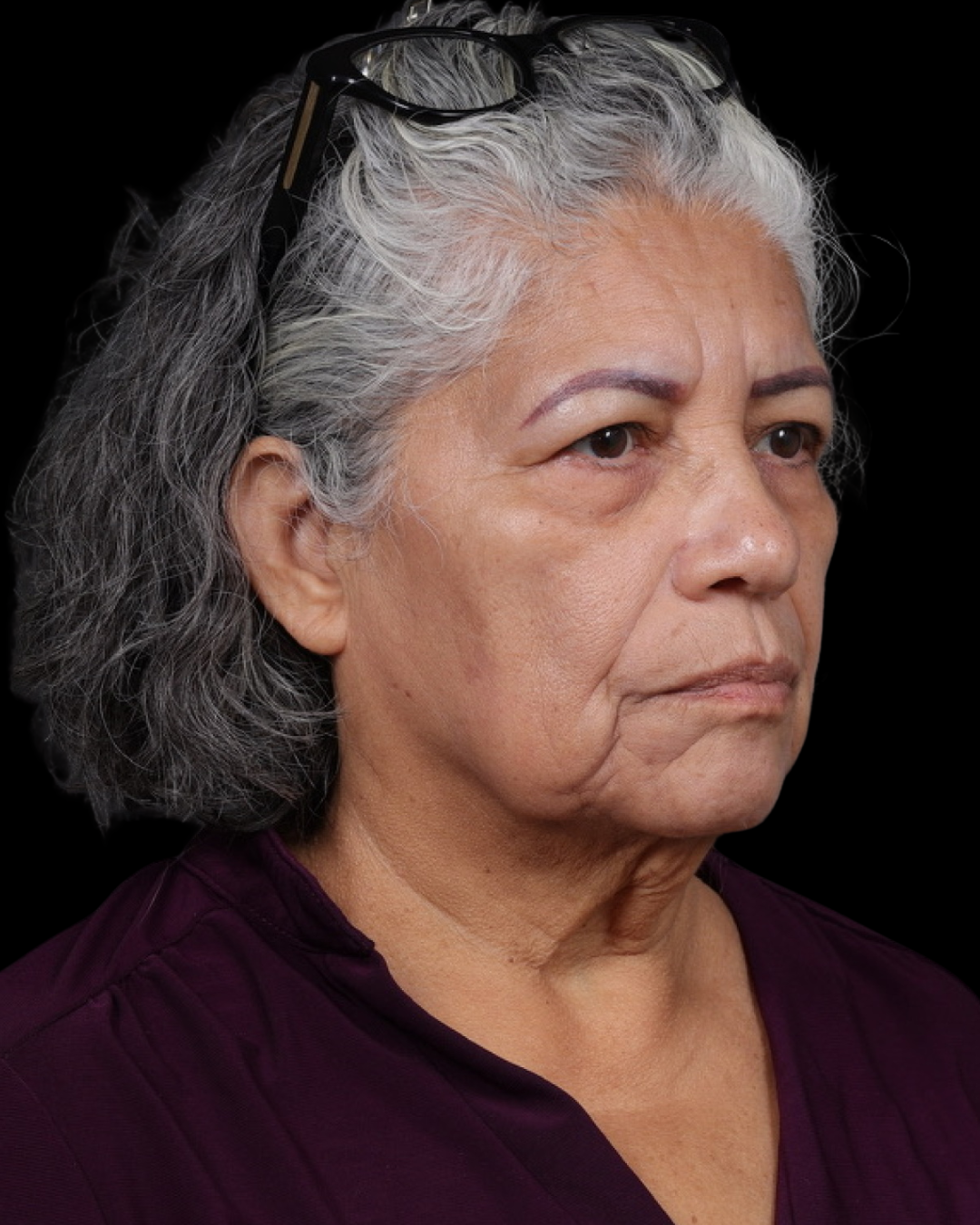 Facelift Before & After Gallery - Patient 364819 - Image 1