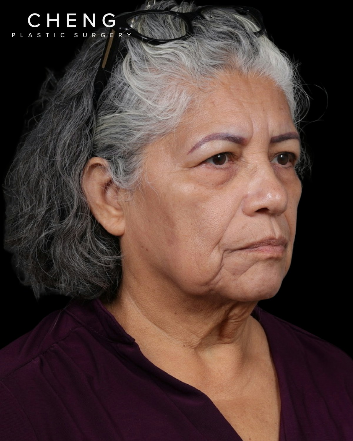 Facelift Before & After Gallery - Patient 364819 - Image 1