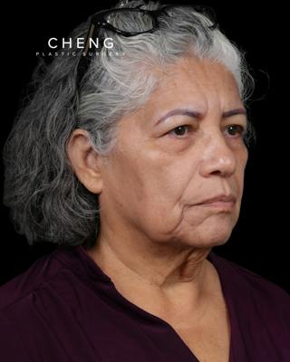 Facelift Before & After Gallery - Patient 364819 - Image 1