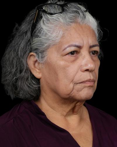Facelift Before & After Gallery - Patient 364819 - Image 1