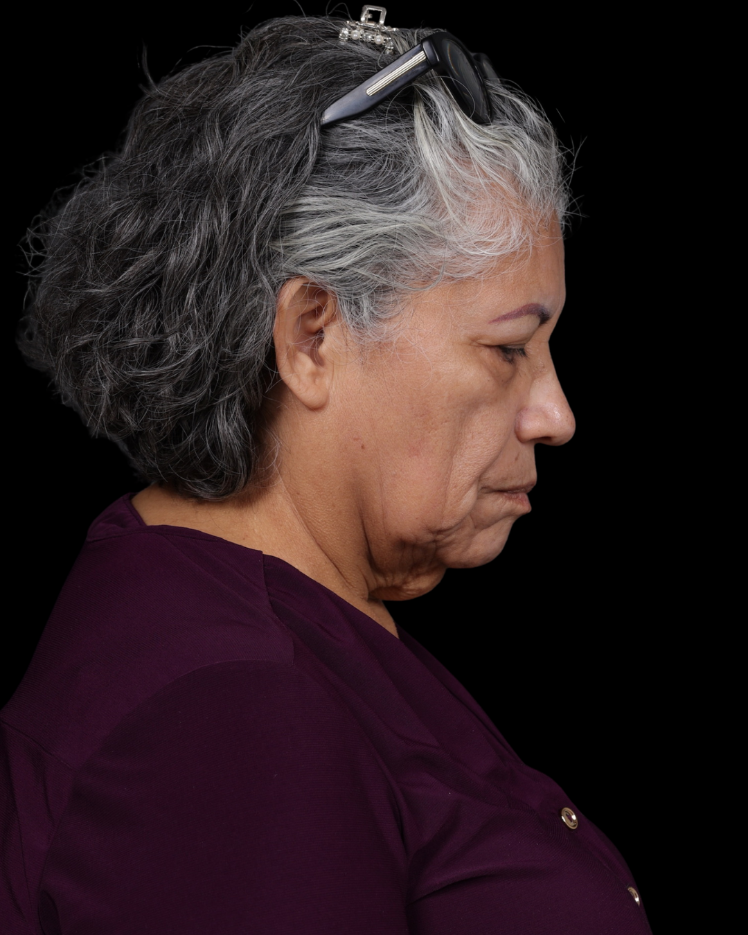 Facelift Before & After Gallery - Patient 364819 - Image 7