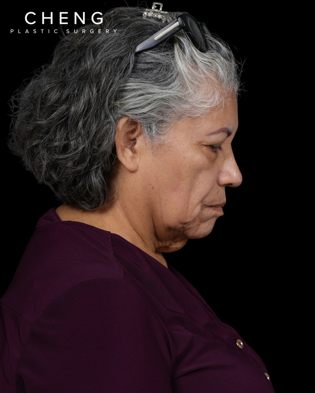 Facelift Before & After Gallery - Patient 364819 - Image 7