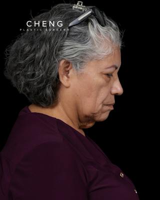 Facelift Before & After Gallery - Patient 364819 - Image 7