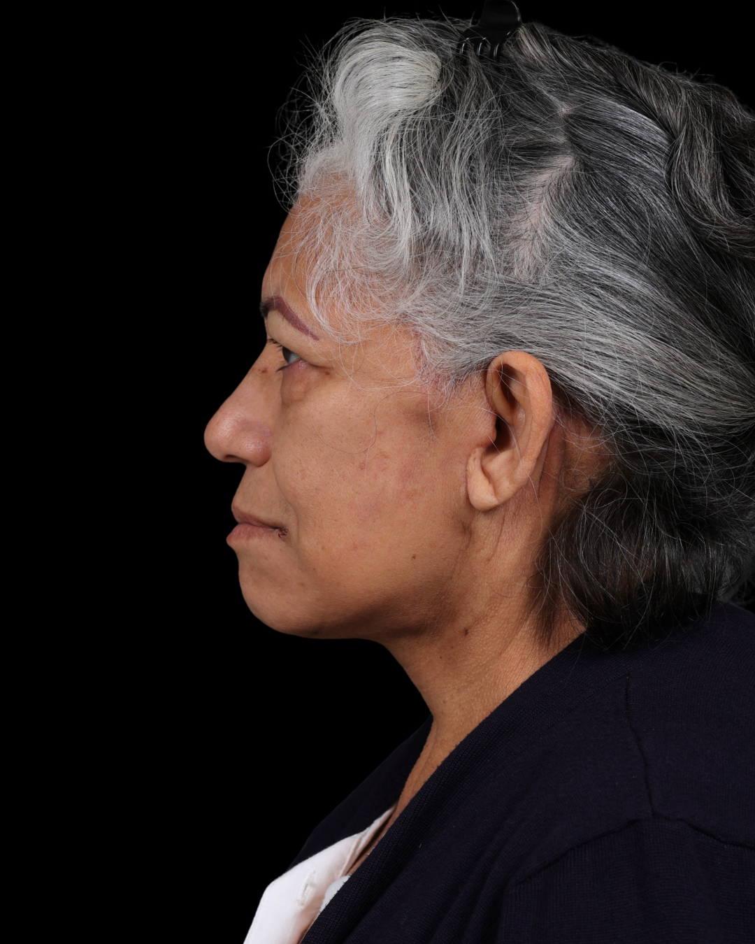 Facelift Before & After Gallery - Patient 364819 - Image 12