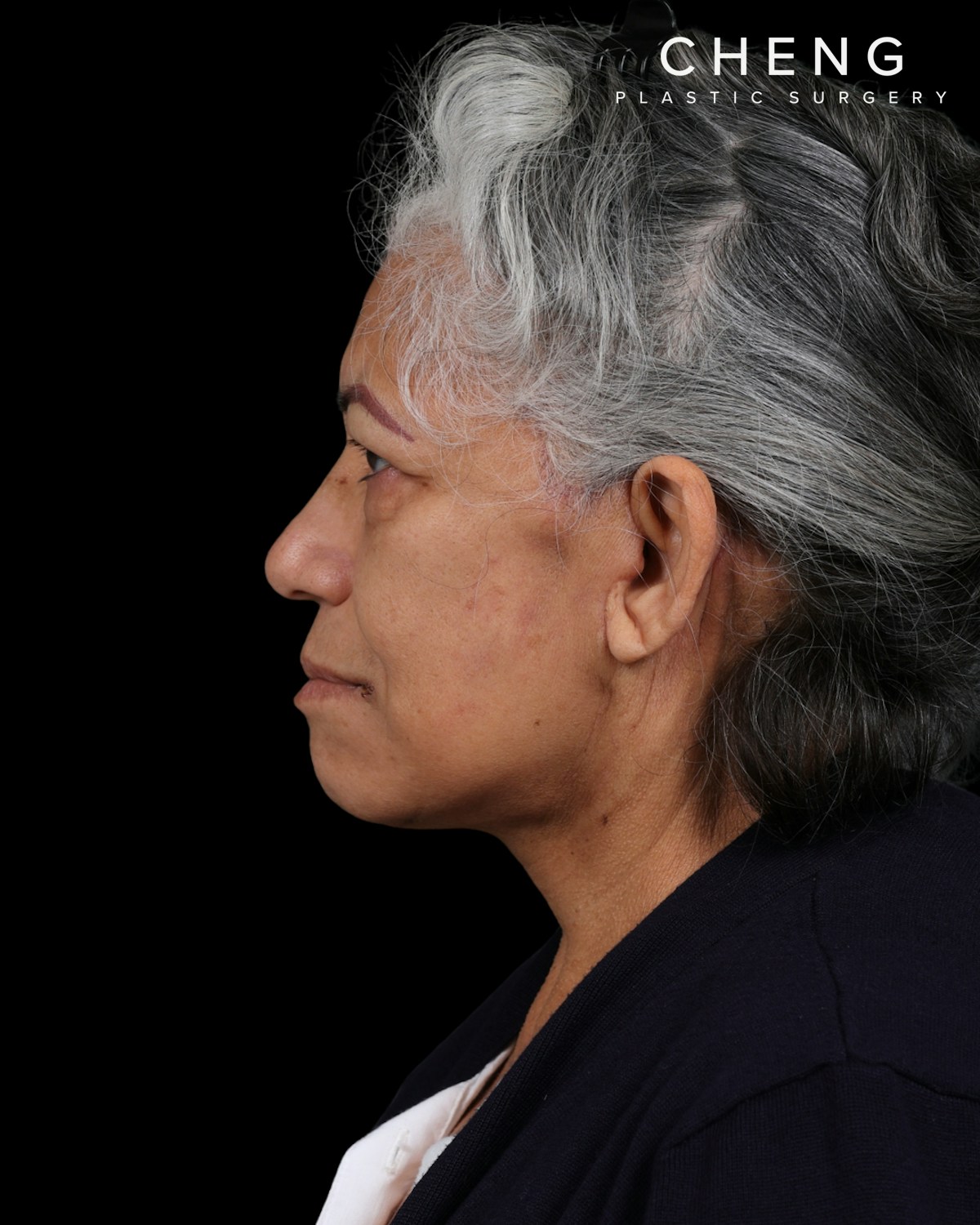 Facelift Before & After Gallery - Patient 364819 - Image 12